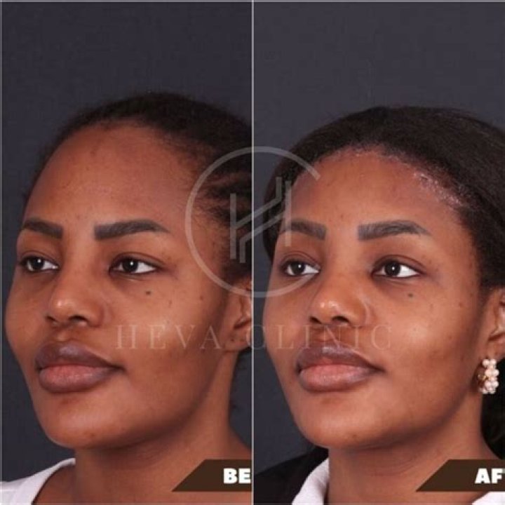 Tomi Lahren Forehead Reduction 2024: Before And After Photos